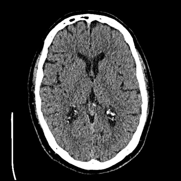 File:Acute A3 occlusion with ACA ischemic penumbra (CT perfusion) (Radiopaedia 72036-82525 Axial non-contrast thins 36).jpg