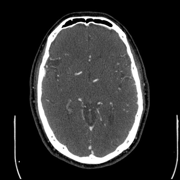 File:Acute A3 occlusion with ACA ischemic penumbra (CT perfusion) (Radiopaedia 72036-82527 Axial C+ arterial phase thins 80).jpg