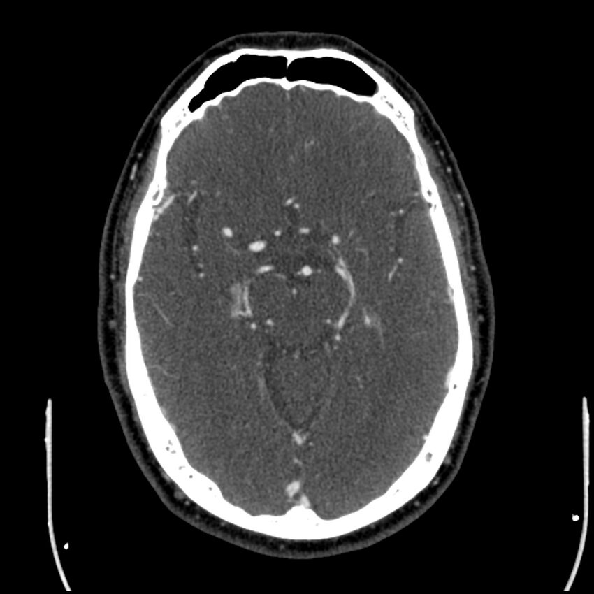 Acute A3 occlusion with ACA ischemic penumbra (CT perfusion) (Radiopaedia 72036-82527 Axial C+ arterial phase thins 93).jpg