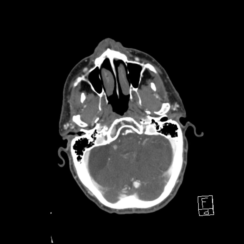 Acute ICA ischemic penumbra due to high-grade CCA stenosis (CT perfusion) (Radiopaedia 72038-82530 Axial C+ arterial phase 19).jpg
