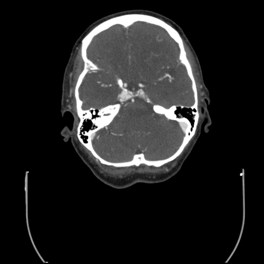 Acute M1 occlusion with ischemic penumbra (CT perfusion) (Radiopaedia 71897-82344 Axial C+ arterial phase thins 105).jpg
