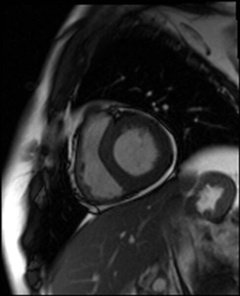 File:Acute anteroseptal myocardial infarction (Radiopaedia 68409-77944 Short axis (basal) SSFP cine 4).jpg