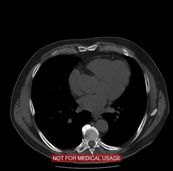 File:Acute aortic dissection - Stanford type A (Radiopaedia 40661-43285 Axial non-contrast 37).jpg