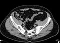 Acute appendicitis (Radiopaedia 13030-13091 Axial non-contrast 62).jpg