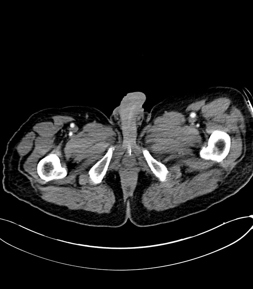 Acute arterial mesenteric ischemia (Radiopaedia 78238-90828 Axial C+ arterial phase 156).jpg