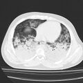 Acute aspiration pneumonitis (Radiopaedia 33605-34703 Axial lung window 66).jpg