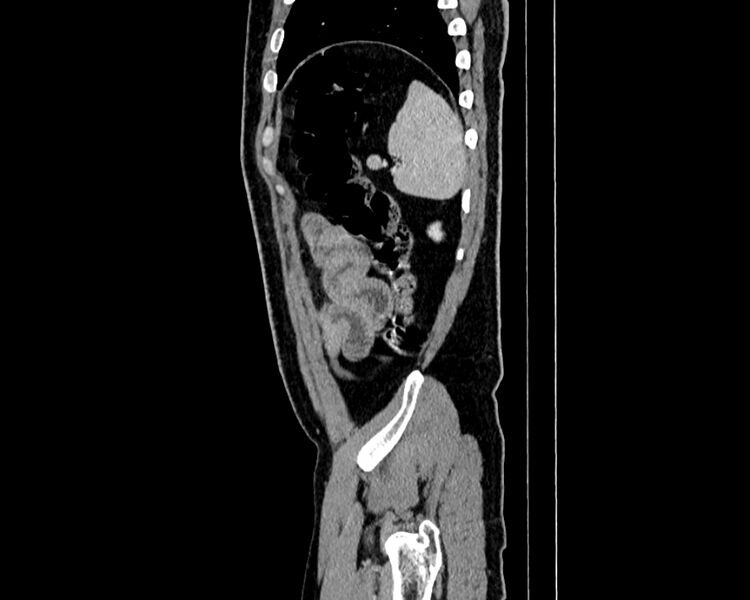 File:Acute cholecystitis (Radiopaedia 53216-59182 Sagittal C+ portal venous phase 21).jpg