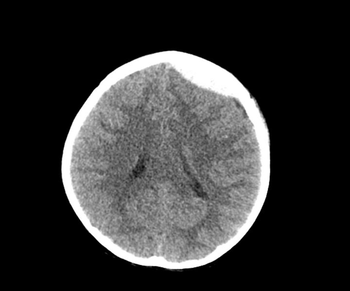 File:Acute epidural hematoma (Radiopaedia 63659-72335 Axial non-contrast 15).jpg