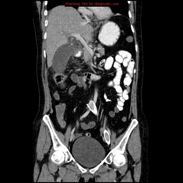 File:Acute gangrenous cholecystitis (Radiopaedia 10123-10661 Coronal C+ portal venous phase 12).jpg
