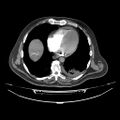 Acute heart failure (CT) (Radiopaedia 79835-93075 Axial C+ arterial phase 41).jpg