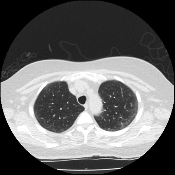 File:Acute interstitial pneumonitis (Radiopaedia 45404-49444 Axial lung window 23).jpg