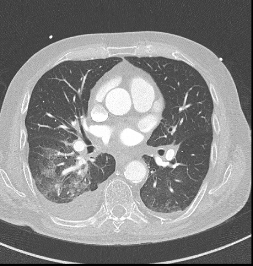 Acute myocardial infarction (Radiopaedia 23413-23481 lung window 29).jpg