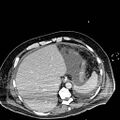 Acute pancreatic necrosis (Radiopaedia 13560-18501 Axial C+ portal venous phase 18).jpg