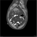 Acute pancreatitis (Radiopaedia 19135-19116 Coronal non-contrast 2).jpg