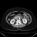 Acute pancreatitis - Balthazar C (Radiopaedia 26569-26714 Axial C+ arterial phase 42).jpg