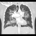 Acute pulmonary edema on CT (Radiopaedia 33582-34672 Coronal lung window 19).jpg