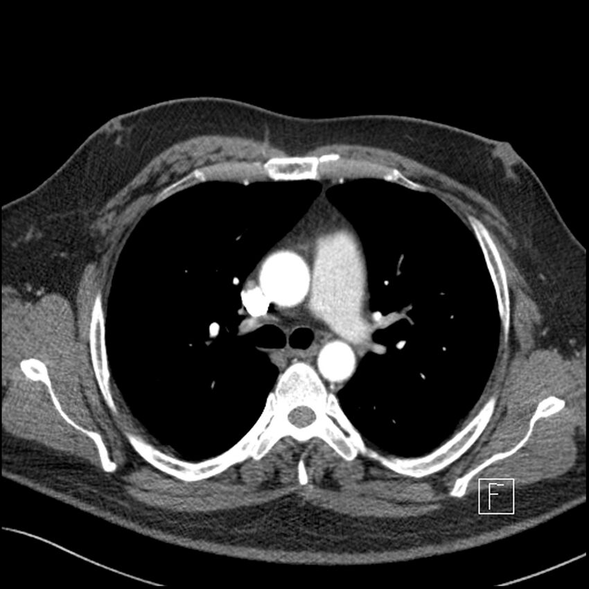 Acute pulmonary embolism with pulmonary infarct (Radiopaedia 73062-83768 Axial C+ CTPA 27).jpg