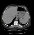 Acute renal failure post IV contrast injection- CT findings (Radiopaedia 47815-52559 Axial C+ portal venous phase 15).jpg