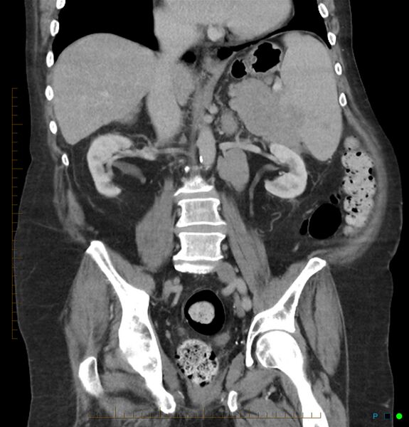 File:Acute renal failure post IV contrast injection- CT findings (Radiopaedia 47815-52559 Coronal C+ portal venous phase 18).jpg