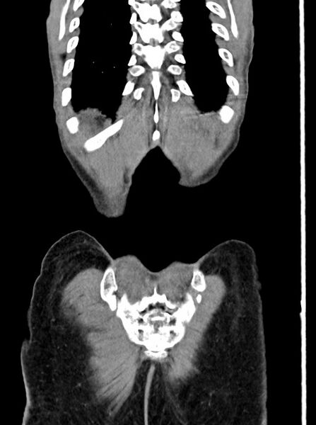 File:Acute small bowel (ileal) volvulus (Radiopaedia 71740-82139 Coronal C+ portal venous phase 103).jpg
