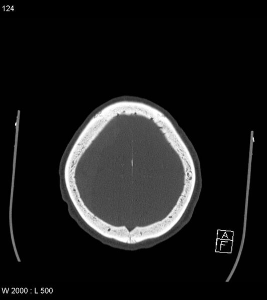 File:Acute subdural hematoma with myelofibrosis (Radiopaedia 52582-58494 Axial bone window 62).jpg