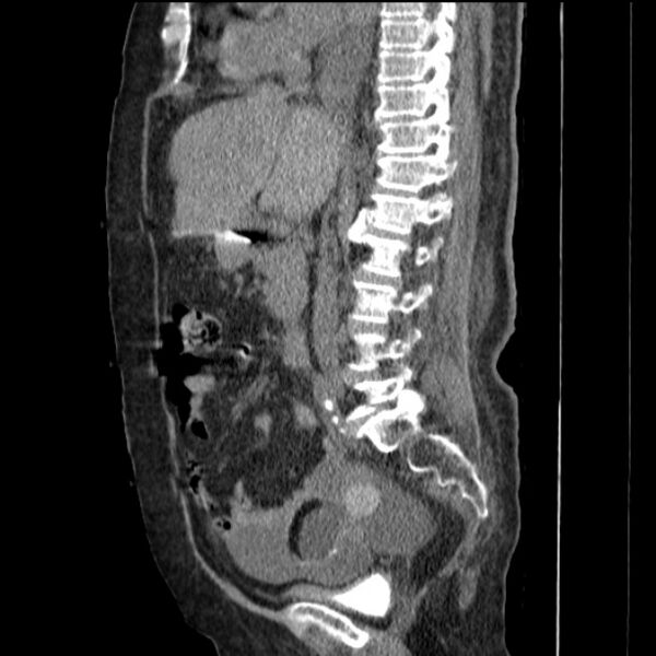 File:Acute tubular necrosis (Radiopaedia 28077-28334 H 42).jpg