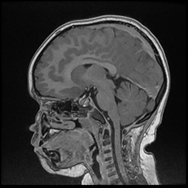 File:Adamantinomatous craniopharyngioma (Radiopaedia 77407-89529 Sagittal T1 C+ 73).jpg