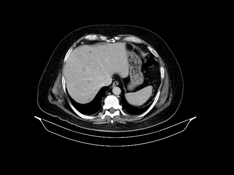 File:Adenocarcinoma of pancreas with hepatic metastasis (Radiopaedia 64332-73122 Axial C+ delayed 18).jpg