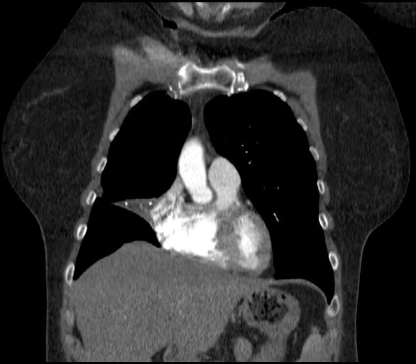 Adenocarcinoma of the lung (Radiopaedia 44205-47803 Coronal C+ portal venous phase 23).jpg