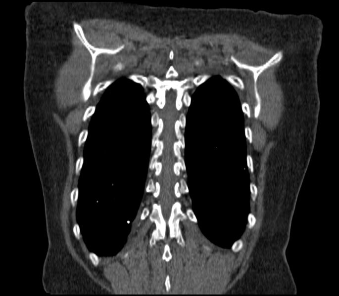 File:Adenocarcinoma of the lung (Radiopaedia 44205-47803 Coronal C+ portal venous phase 85).jpg