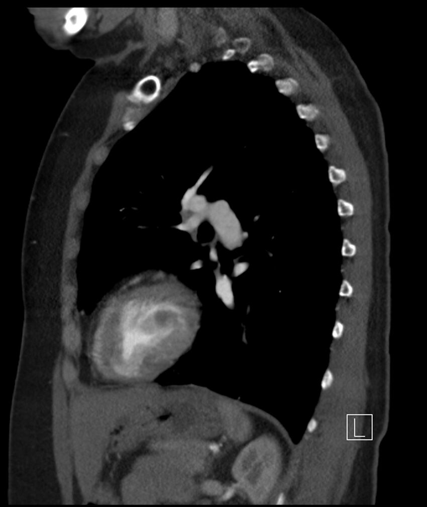 Adenocarcinoma of the lung (Radiopaedia 44205-47803 Sagittal C+ portal venous phase 21).jpg