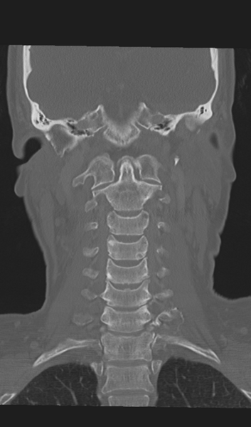 File:Adenoid cystic tumor of palate (Radiopaedia 46980-51518 Coronal bone window 40).png
