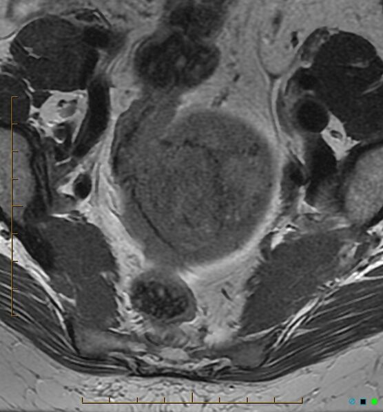 File:Adenomyosis uterus with hematometra (Radiopaedia 45779-50011 Axial T2 6).jpg