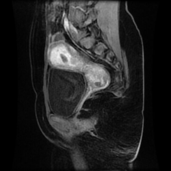 File:Adenomyosis within a septate uterus (Radiopaedia 69963-79981 Sagittal LAVA-Dyn 21).jpg