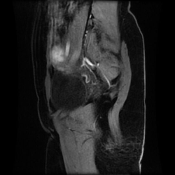 File:Adenomyosis within a septate uterus (Radiopaedia 69963-79981 Sagittal LAVA-Dyn 27).jpg