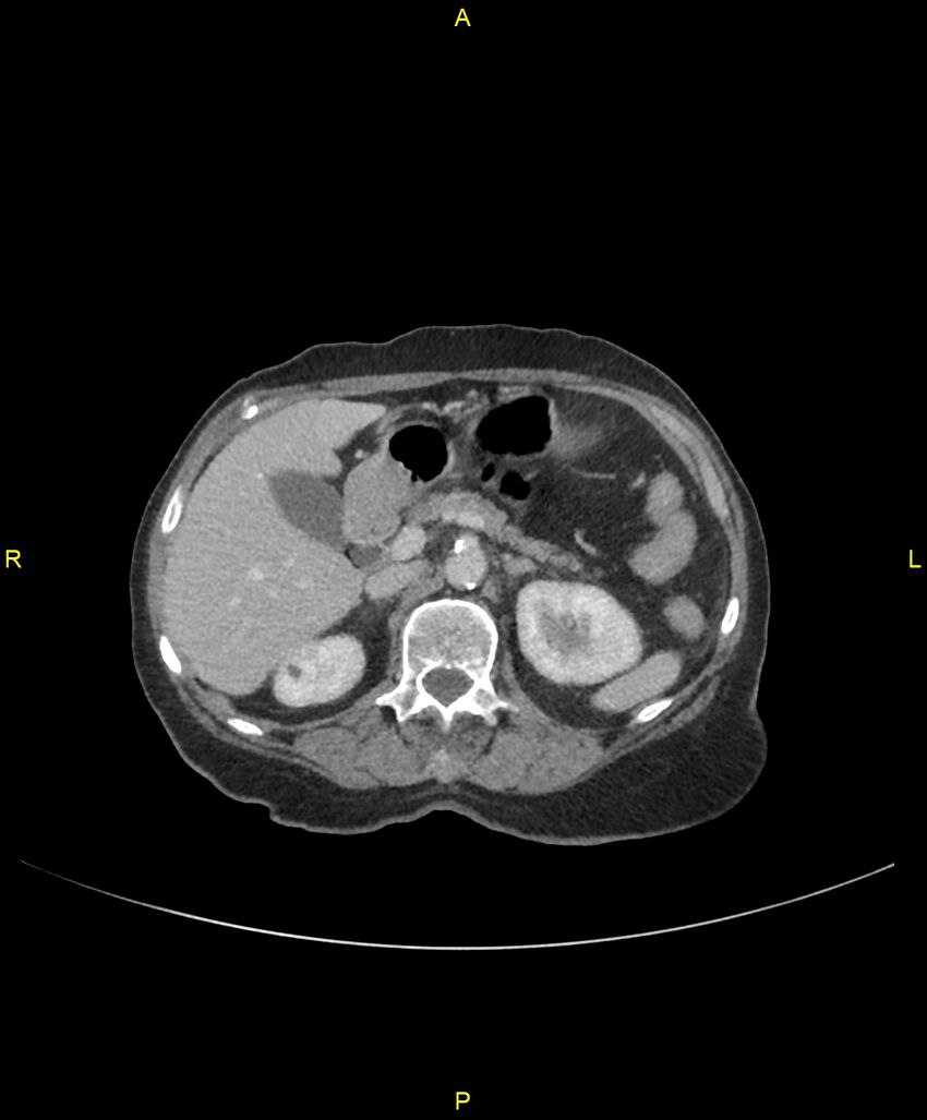 Adhesional small bowel obstruction (Radiopaedia 85402-101024 Axial C+ portal venous phase 89).jpg