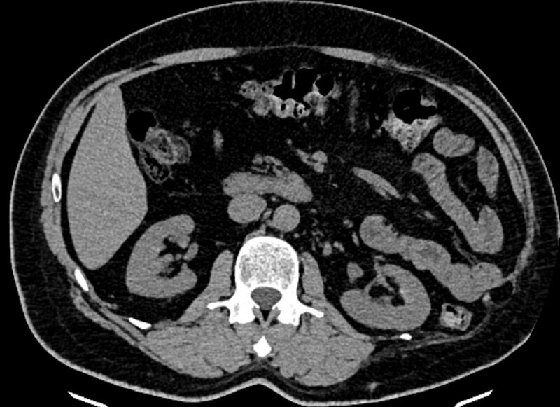 File:Adrenal metastases (Radiopaedia 73082-83791 Axial non-contrast 80).jpg