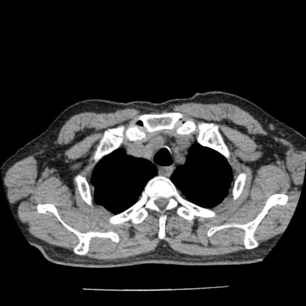 File:Airway foreign body in adult (Radiopaedia 85907-101779 Axial liver window 5).jpg