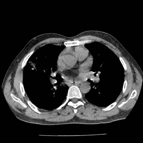 File:Airway foreign body in adult (Radiopaedia 85907-101779 Axial liver window 85).jpg