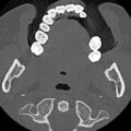 Ameloblastic fibro-odontoma (Radiopaedia 18843-18780 C 53).jpg