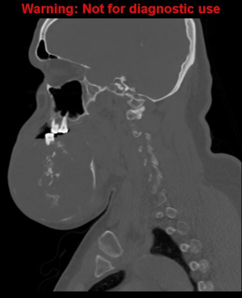 File:Ameloblastoma (Radiopaedia 33126-34164 Sagittal bone window 32).jpg