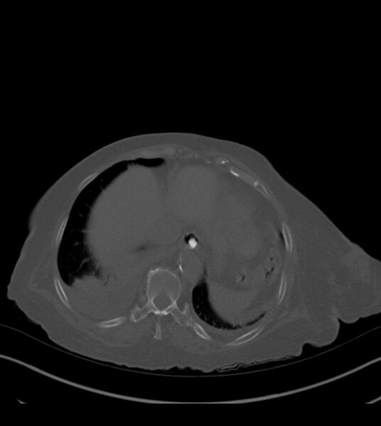 File:Amiodarone deposition in the liver (Radiopaedia 77587-89780 Axial bone window 67).jpg