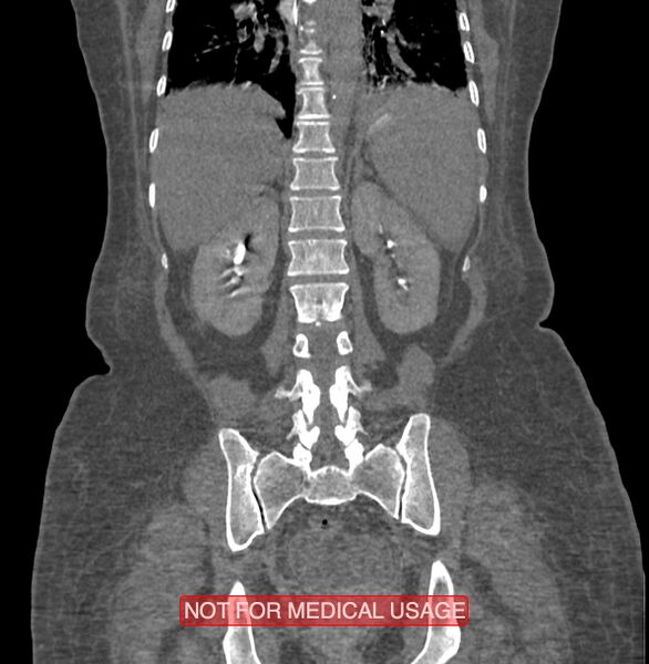 File:Amoebic enterocolitis with liver abscess (Radiopaedia 35100-36609 B 145).jpg