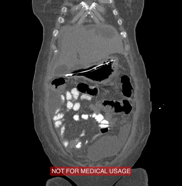 File:Amoebic enterocolitis with liver abscess (Radiopaedia 35100-36609 B 23).jpg