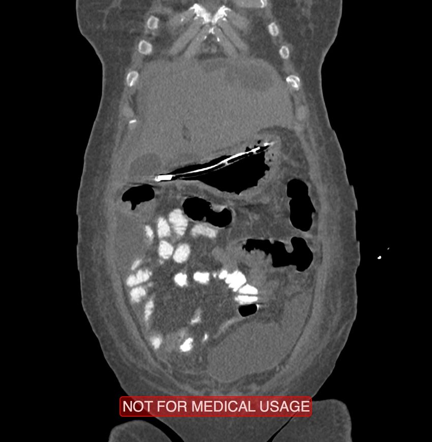 Amoebic enterocolitis with liver abscess (Radiopaedia 35100-36609 B 23).jpg