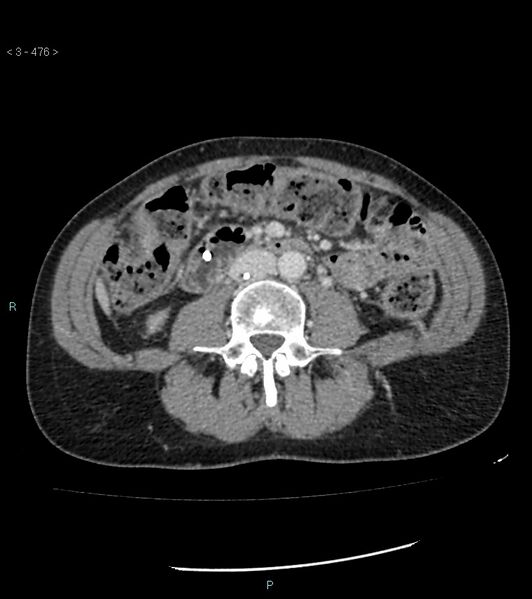 File:Ampulla of Vater metastasis (Radiopaedia 27820-28069 A 114).jpg