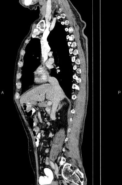File:Ampullary adenocarcinoma (Radiopaedia 86093-102033 E 36).jpg