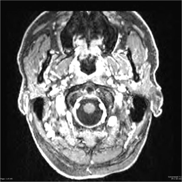 File:Anaplastic meningioma with recurrence (Radiopaedia 34452-35788 Axial T1 C+ 1).jpg