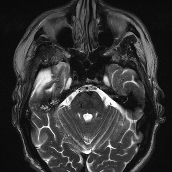 File:Anaplastic meningioma with recurrence (Radiopaedia 34452-35788 Axial T2 3).png