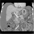 Annular pancreas and cirrhosis (Radiopaedia 24561-24843 B 8).jpg